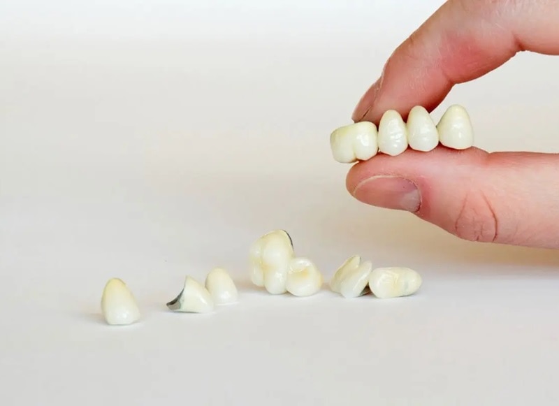 Dental Crowns and Bridges Hoppers Crossing 