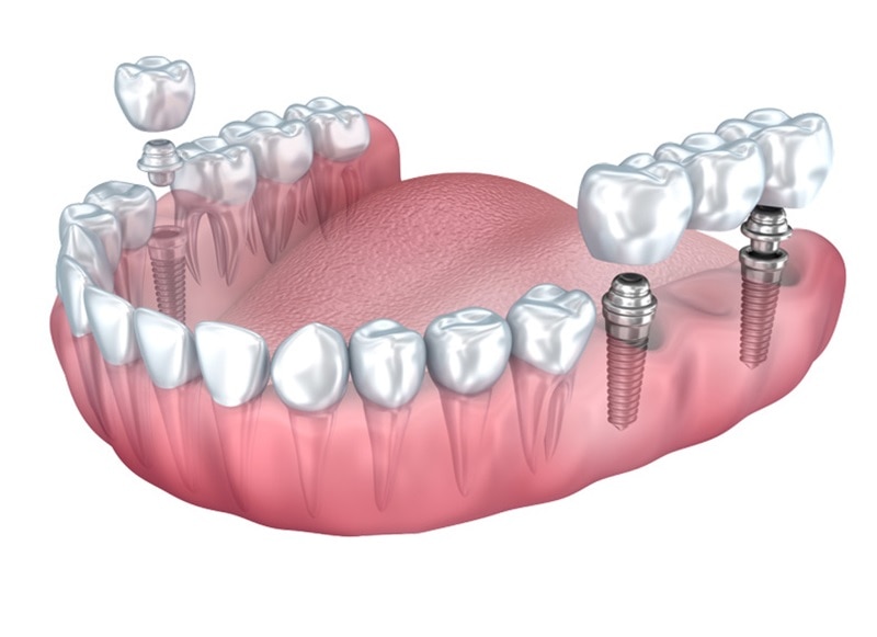 Dental Implants Hoppers Crossing