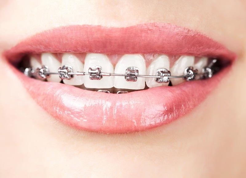 Orthodontics Hoppers Crossing 
